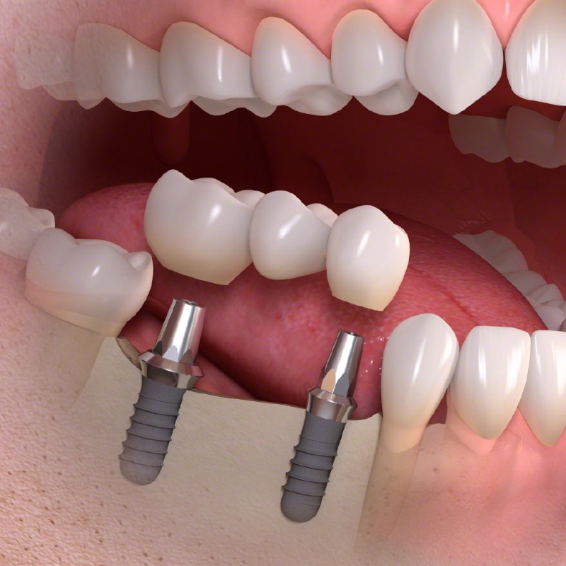 Dental implant option at Portland Perio Implant Center