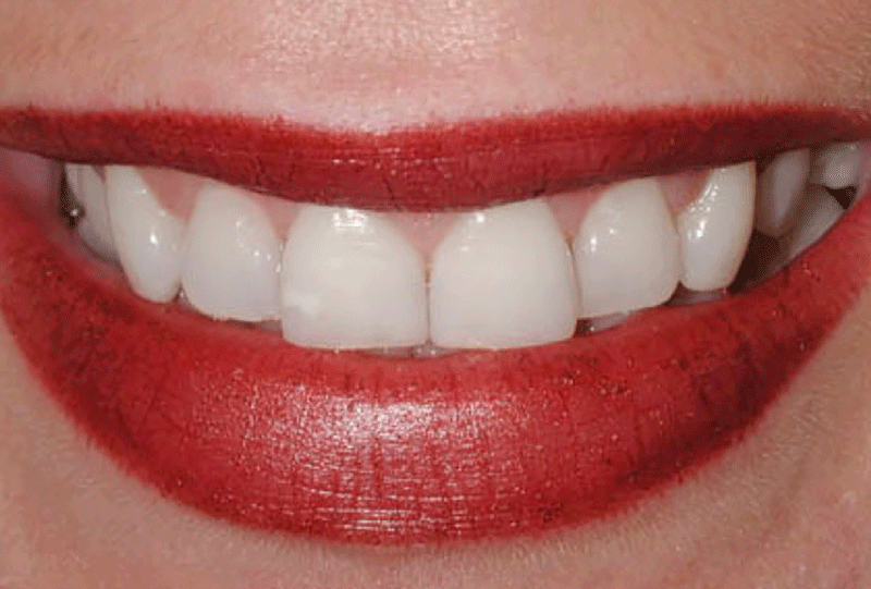 Gummy smile enhancement - after
