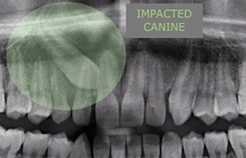 Unerupted canine tooth - radiograph view