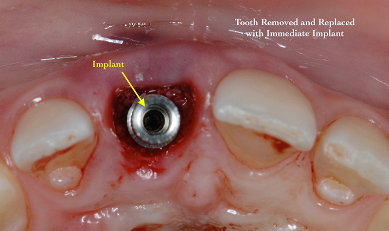 Tooth removed and replaced with immediate implant