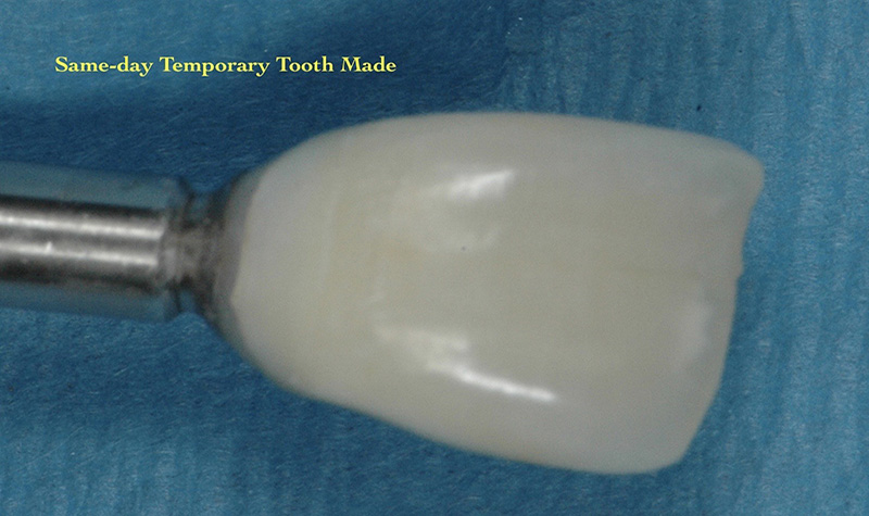 Same-day temporary tooth