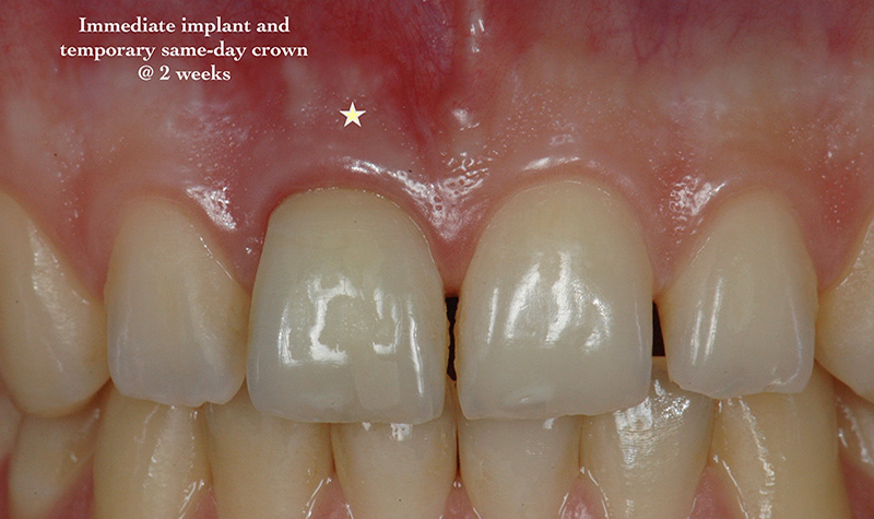 Immediate implant and temporary same-day crown at 2 weeks