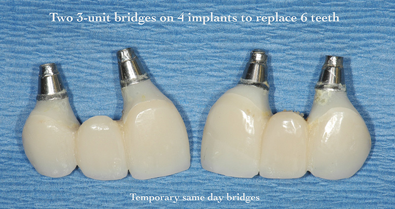 Dental implants to replace missing teeth