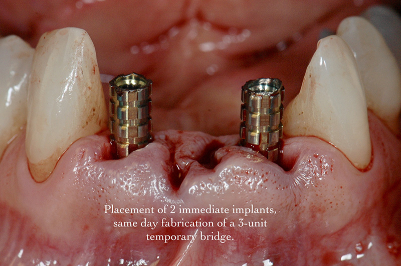 2 immediate implants, same-day fabrication of a 3-unit temporary bridge