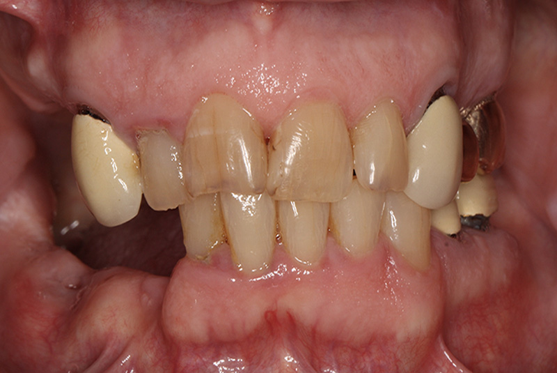 All-on-4 dental implants case study at Portland Perio Implant Center