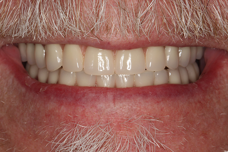 All-on-4 dental implants case study