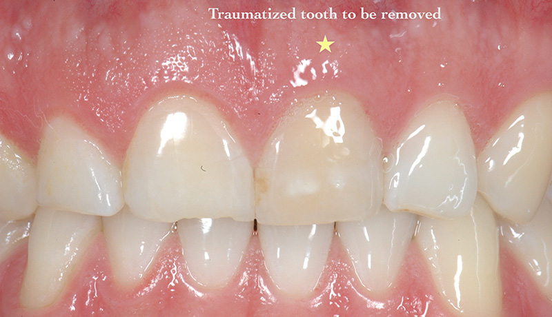 Traumatized tooth to be removed