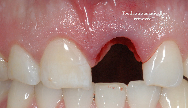 Tooth carefully removed to preserve tissue