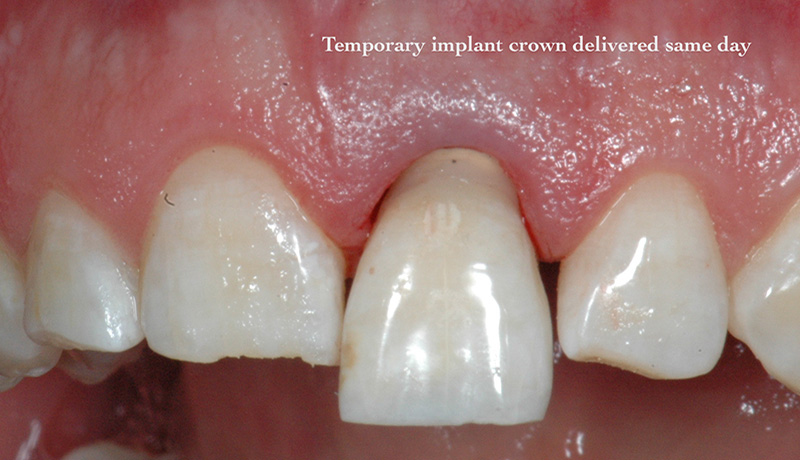 Temporary implant crown delivered same day