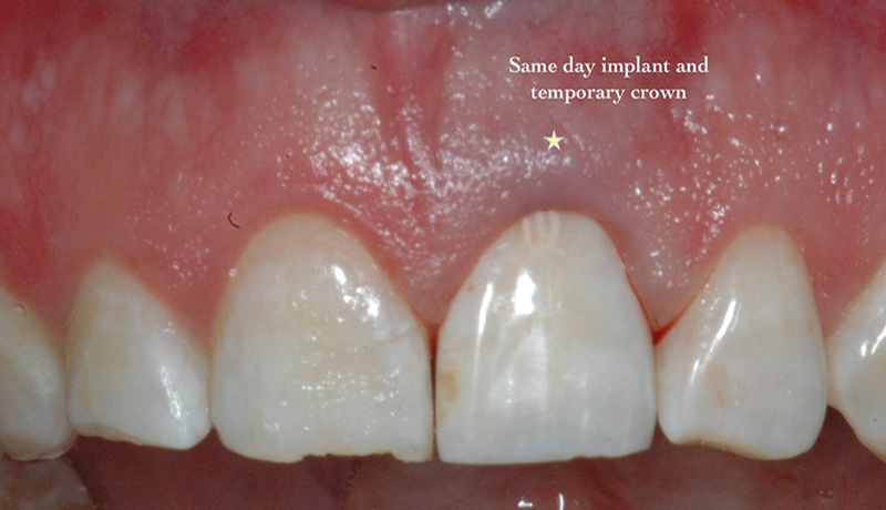 Same-day implant and temporary crown