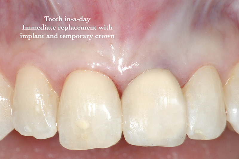 Tooth-in-a-day immediate replacement w/implant and temporary crown
