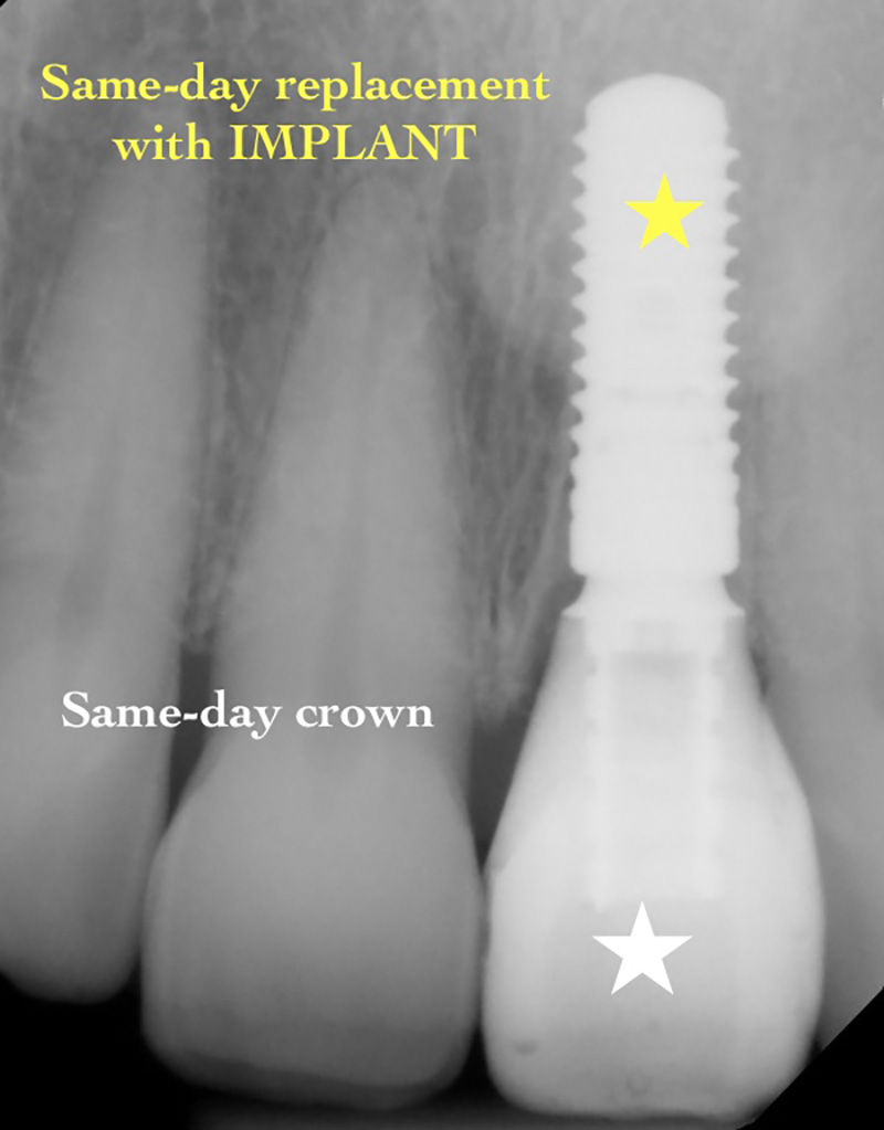 Same-day replacement with dental implant