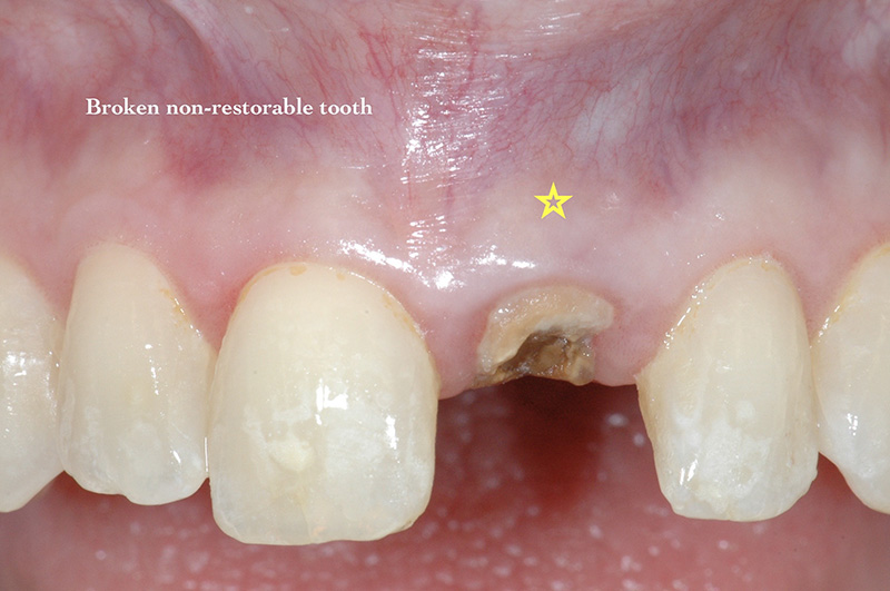 Broken non-restorable tooth