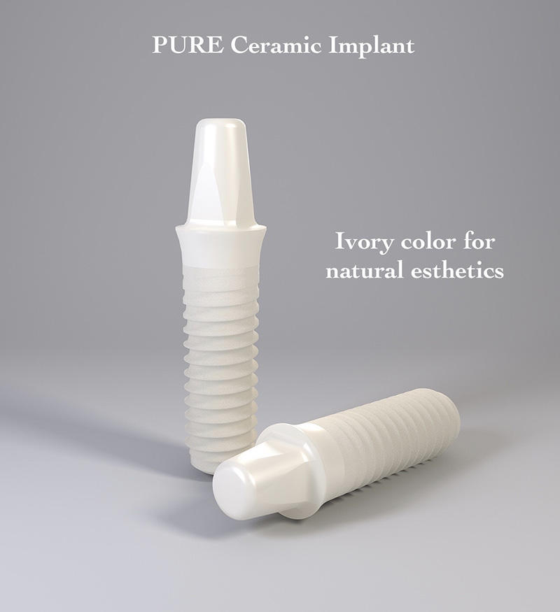Ceramic Implant from Portland Perio Implant Center