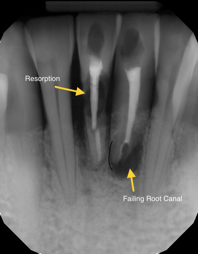 X-ray showing resorption and failing root canal
