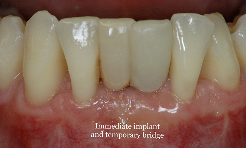 Immediate implant and temporary bridge