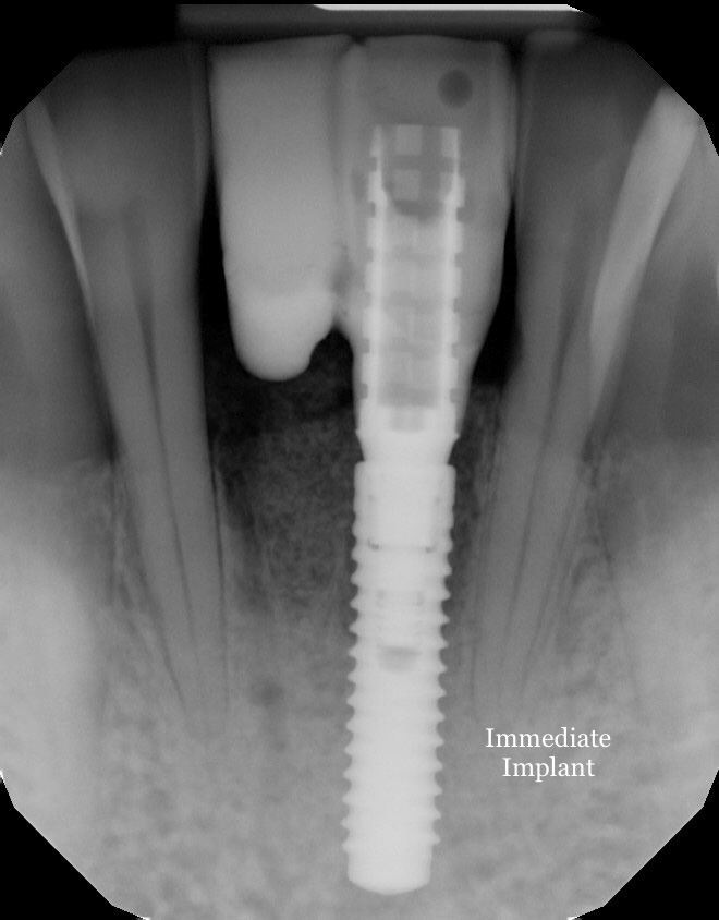 X-ray of immediate implant in place