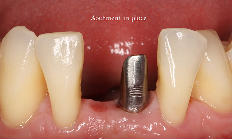 Abutment in place for tooth replacement