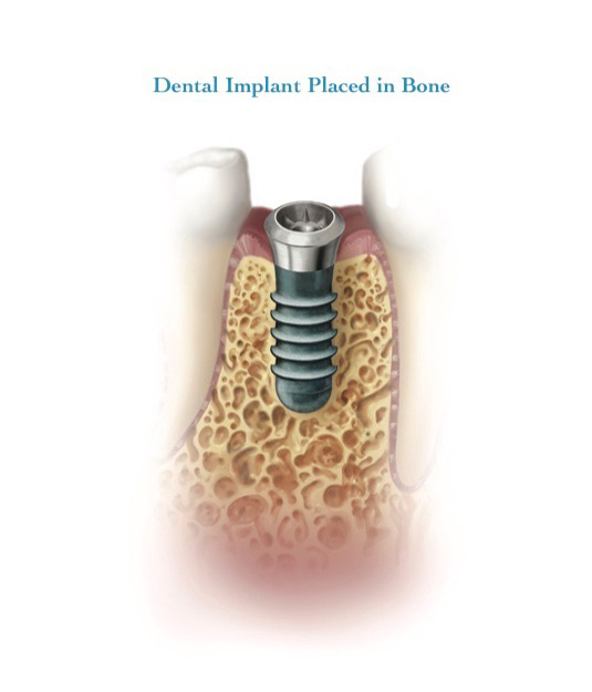 Dental implant placed in the bone