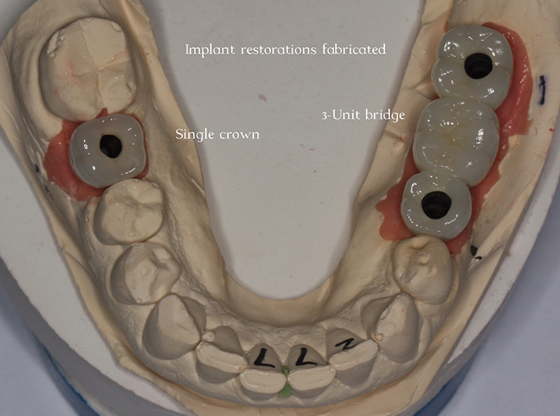 Multiple missing teeth replaced with implants