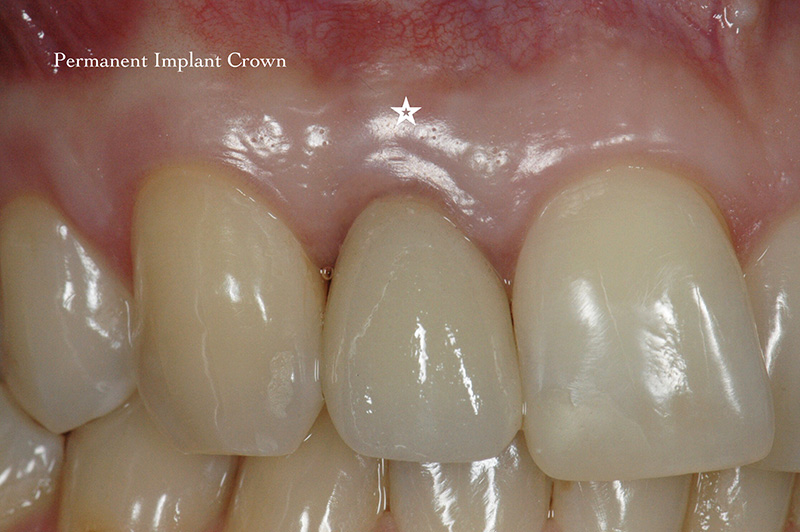 Permanent implant crown