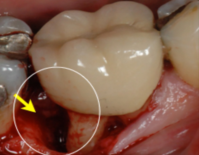Clinical view of periodontal bone loss
