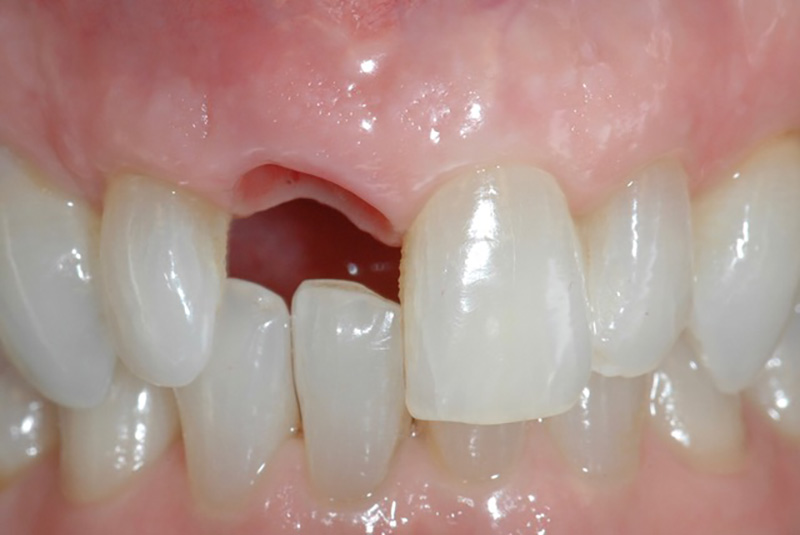 Missing teeth replaced with single and multiple implants