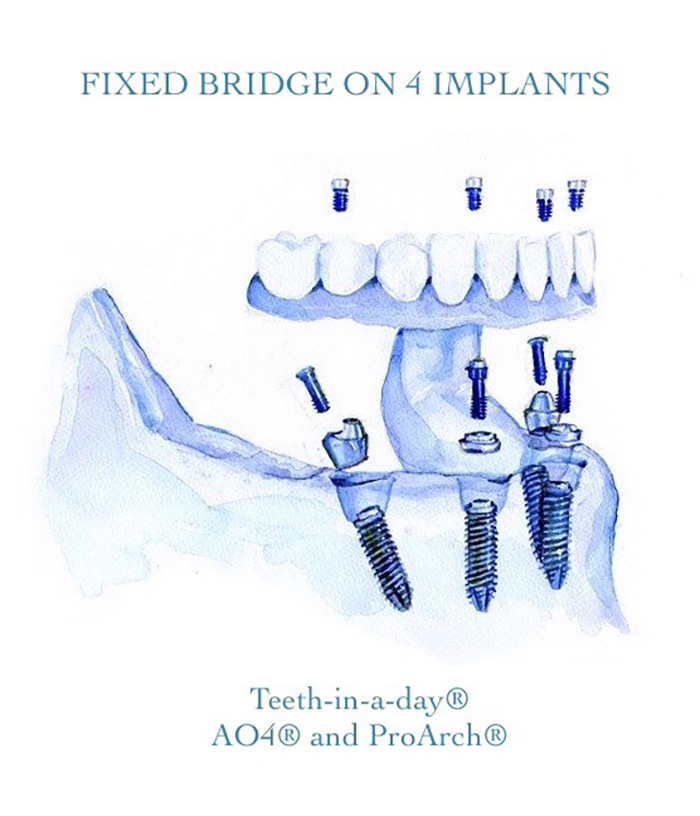 Fixed bridge on 4 implants
