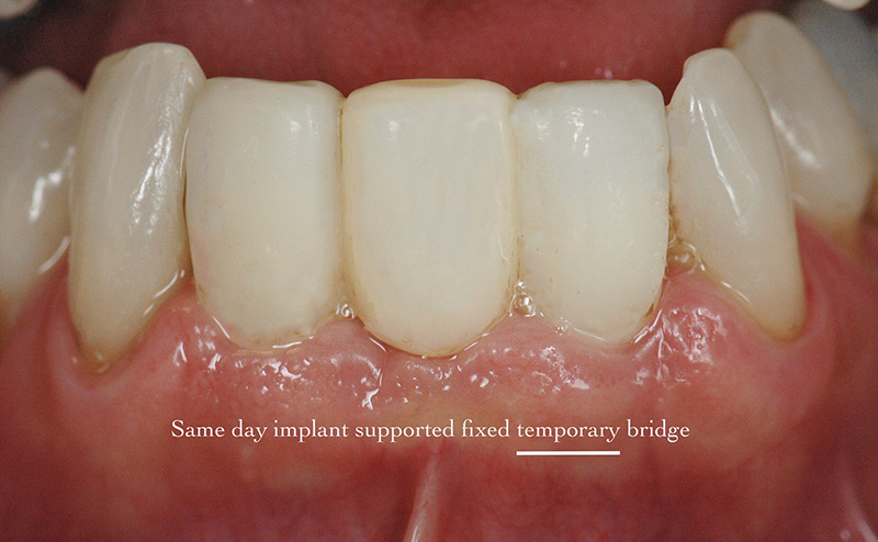 Same day implant-supported fixed temporary bridge