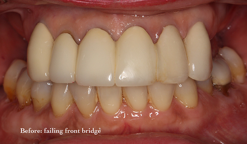 All-On-4 dental Implants patient before treatment