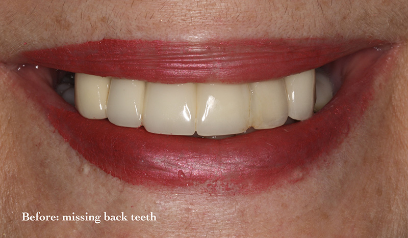 All-On-4 dental Implants patient before treatment