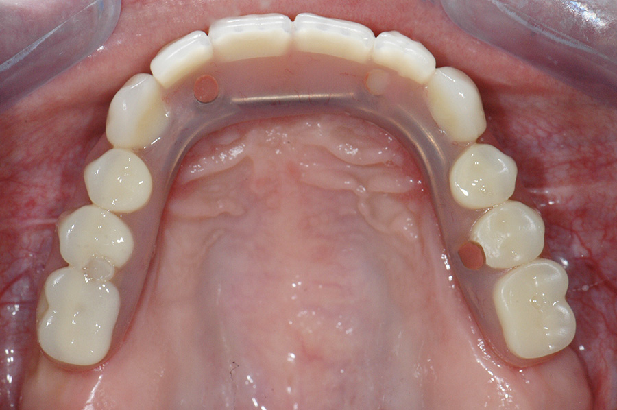 All-On-4 dental implant patient after treatment