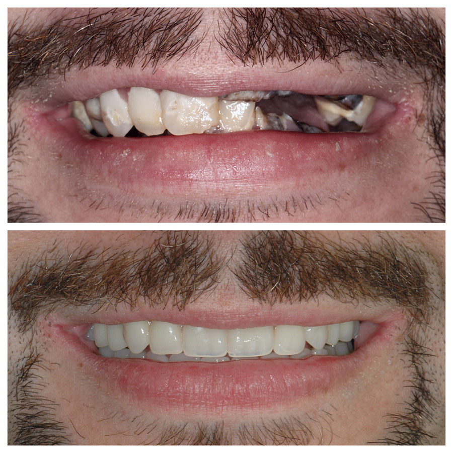 All-On-4 Dental Implant patient at Portland Perio Implant Center