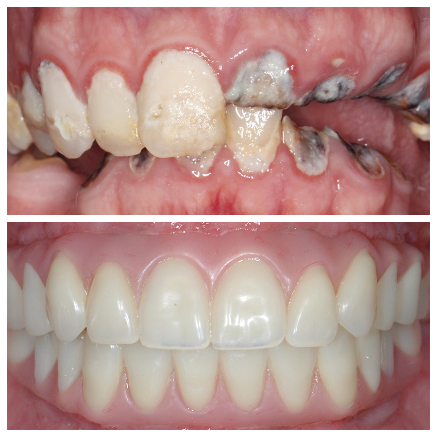 All-On-4 Dental Implant patient at Portland Perio Implant Center