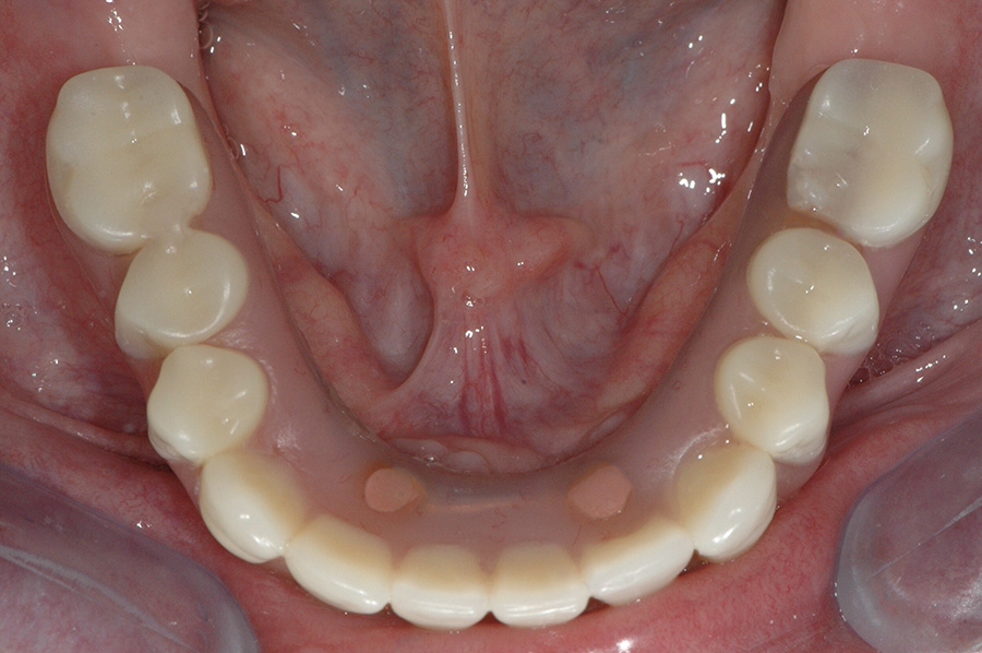 All-On-4 dental implant patient after treatment