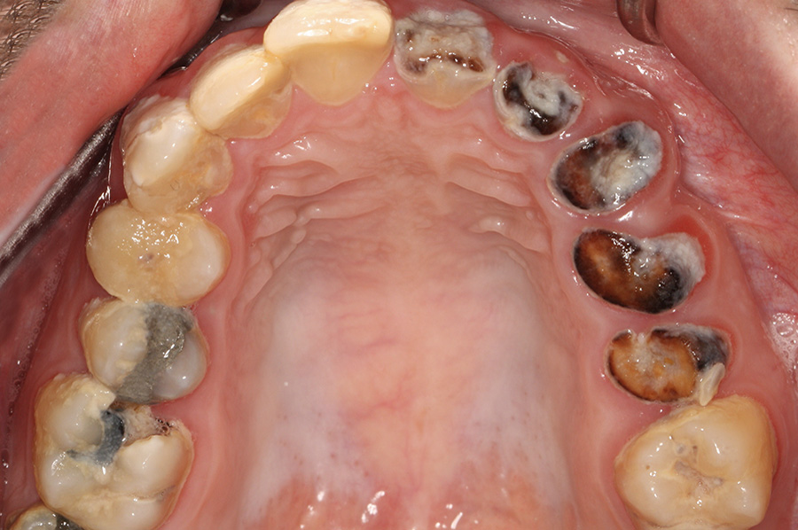 All-On-4 dental implant patient before treatment