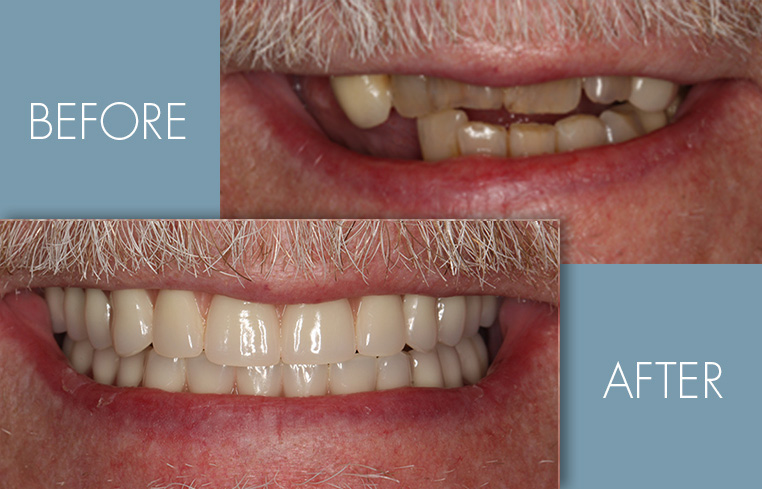 Tom - Before and After Case Study - Patient of Portland Perio Implant Center