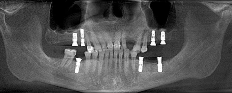 X-ray after treatment showing implants