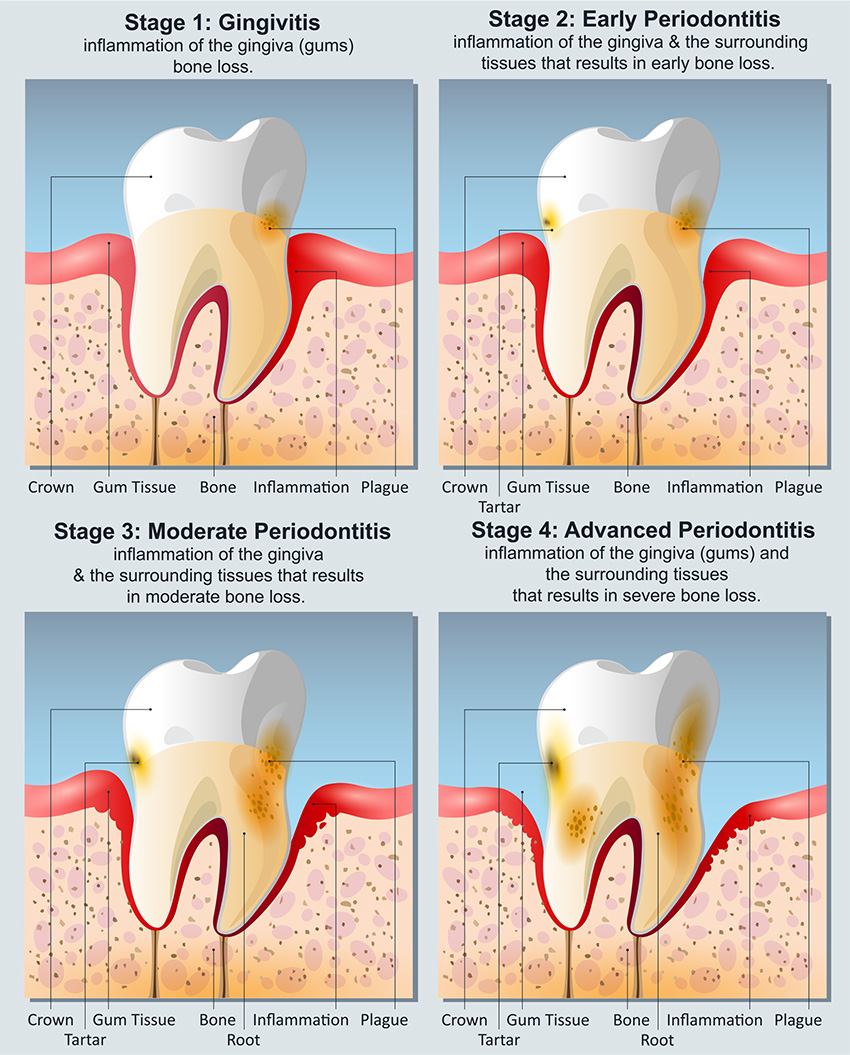 portlandperio-stages-of-gum-disease-1 Stages of Gum Disease