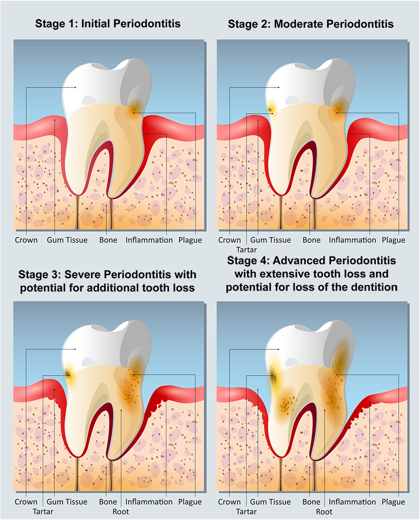 Stages of Periodontitis - Best Periodontist Portland