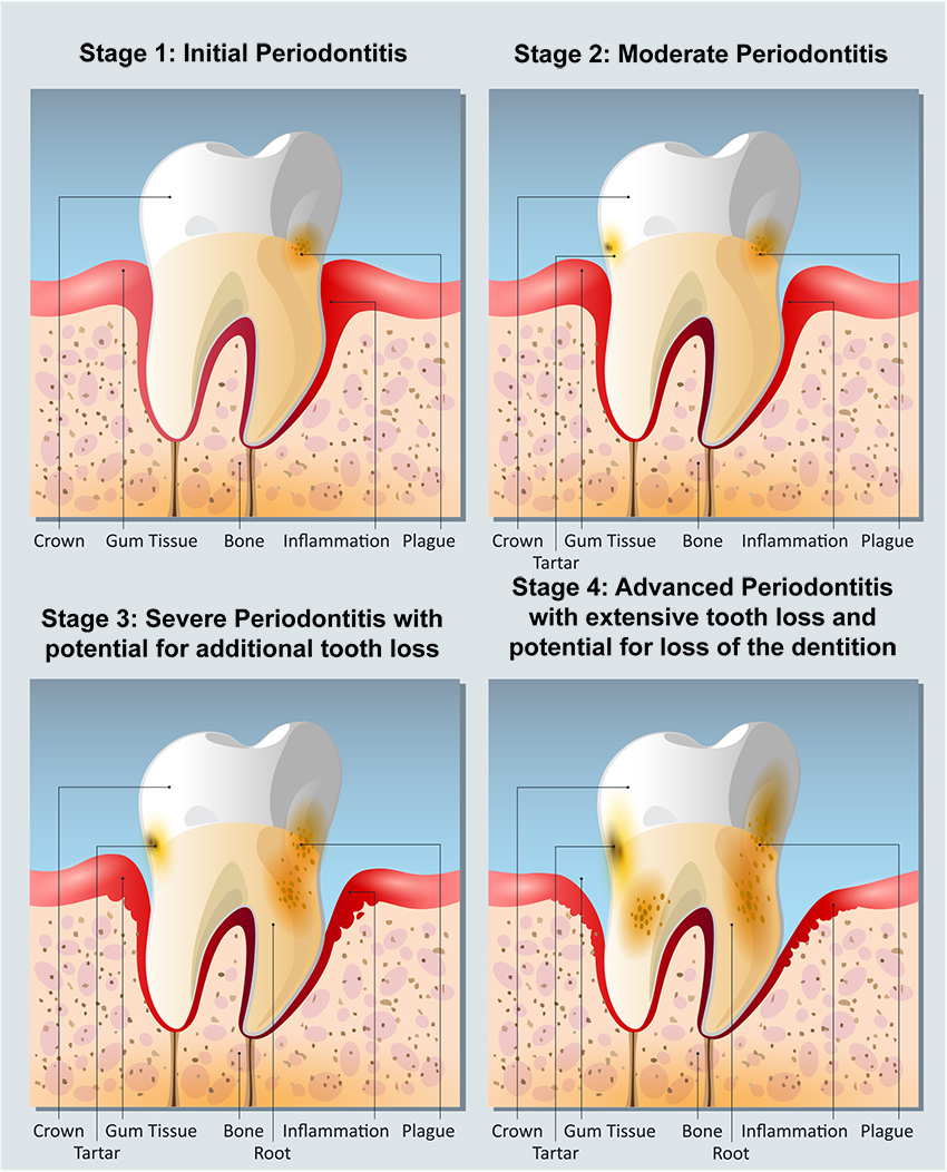 Periodontal Disease Portland Perio Implant Center 0153