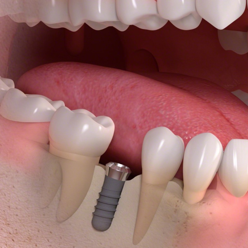 Dental implant option at Portland Perio Implant Center