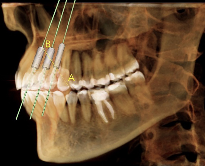 3D planning software for planned dental implants