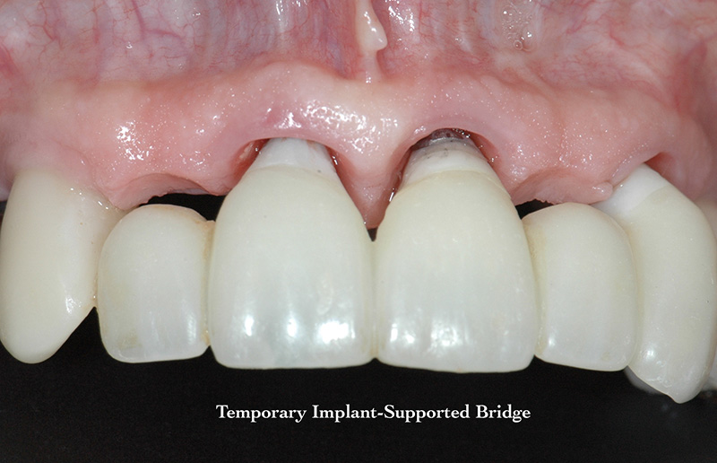 Temporarn implant-supported bridge