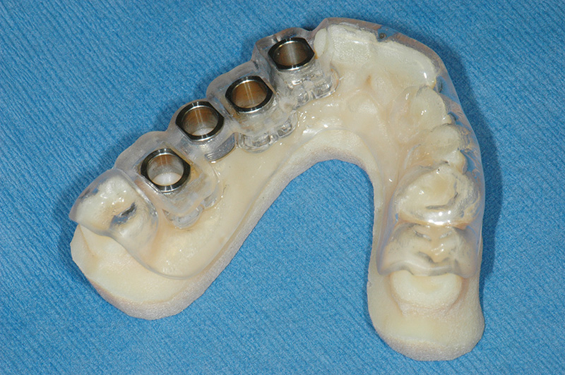Surgical guide used for dental implants
