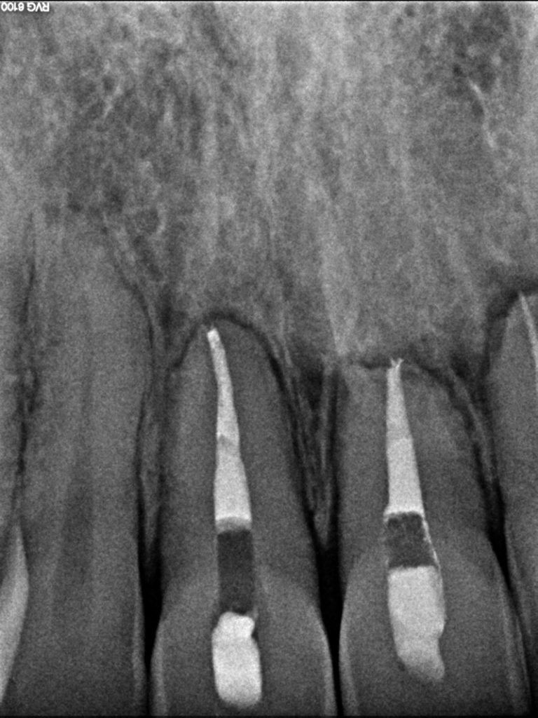 Failing root canals