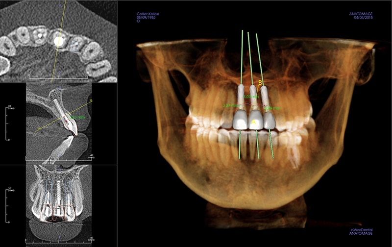 Implants and restoration using 3D software