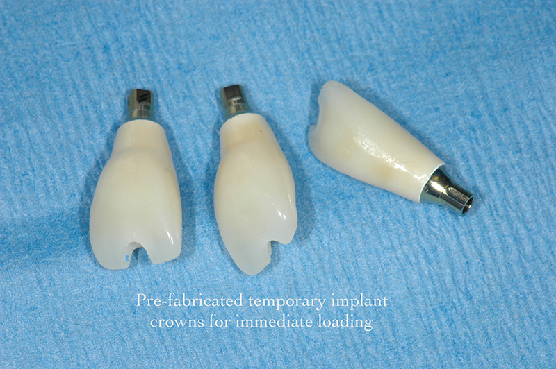 Pre-fabricated temporary crowns for immediate loading