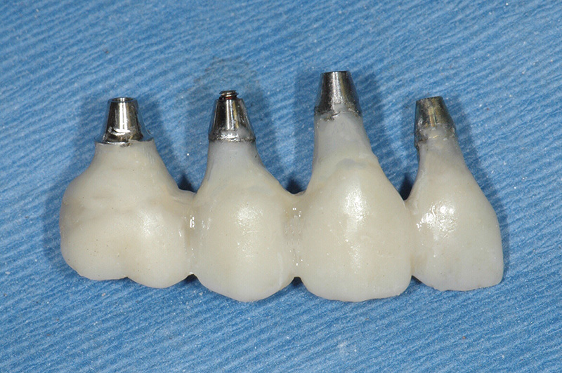 Temporary fixed prosthesis