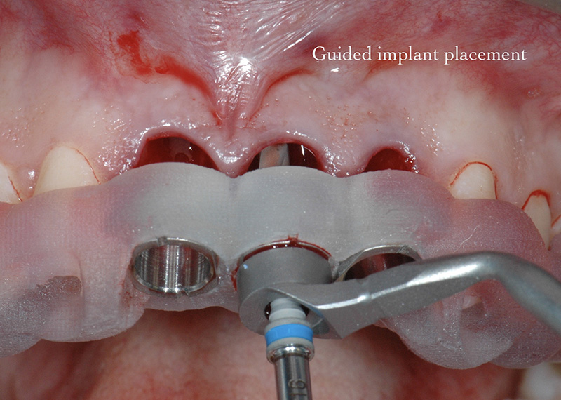 Surgical guide for placement of dental implants